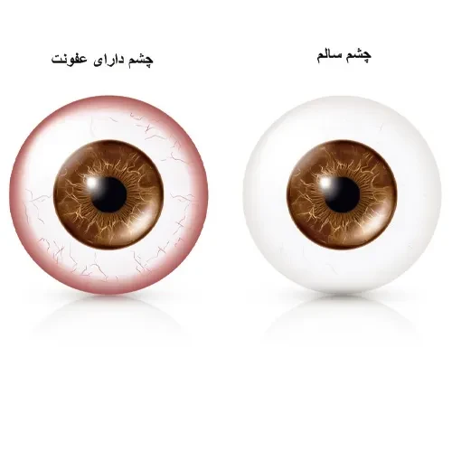 موارد احتیاطی مصرف قطره چشمی کلوبیوتیک
