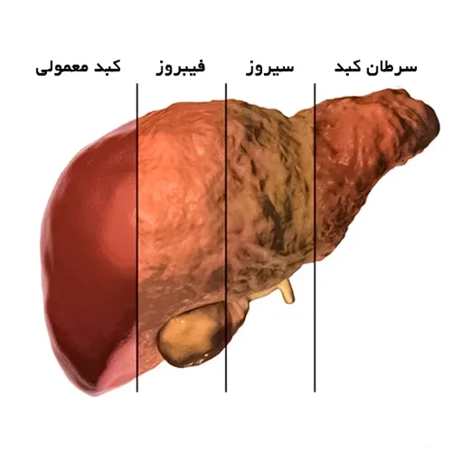 موارد احتیاطی مصرف داروی سیپروفلوکساسین