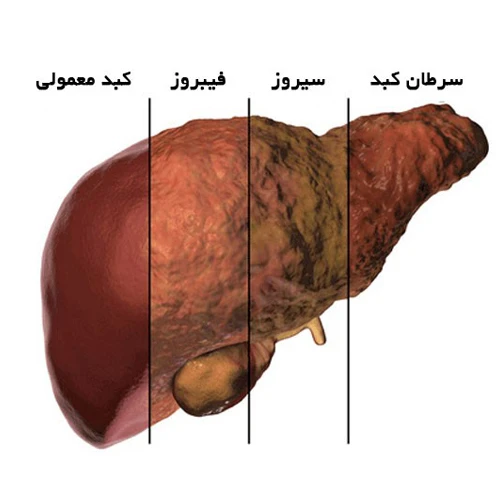 بیماری های کبدی از موارد احتیاطی مصرف داروی کلیندامایسین