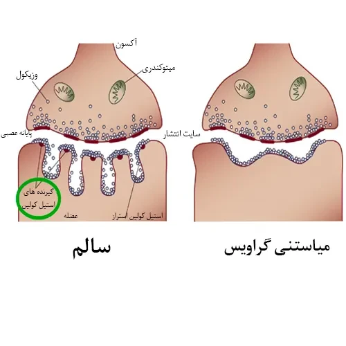 بیماری میاستنی گراویس از موارد احتیاطی مصرف داروی کلیستیمتات