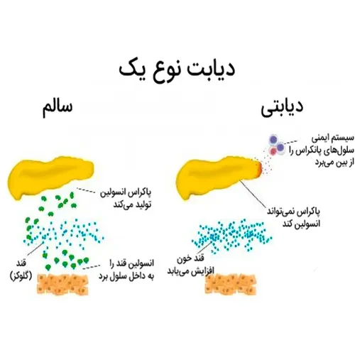 دیابت از موارد احتیاطی مصرف داروی کوپانلیسیب 