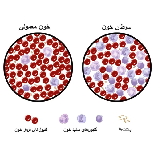 دائونوروبیسین و سیتارابین لیپوزومال موثر بر درمان سرطان خون