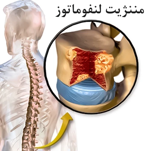 سیتارابین لیپوزومال (Cytarabine) موثر در مننژیت لنفوماتوز