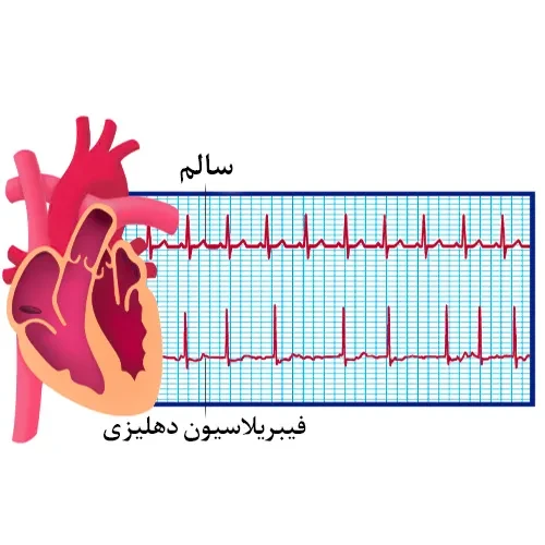 استفاده از داروی دابیگاتران در بیماری فیبریلاسیون دهلیزی