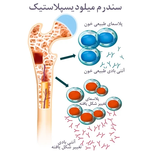 داروی دسیتابین در درمان سندروم میلو دیستپلاستیک