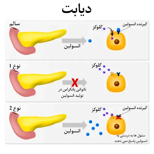 کنترل قند خون در بیماری دیابت با داروی کیوترن