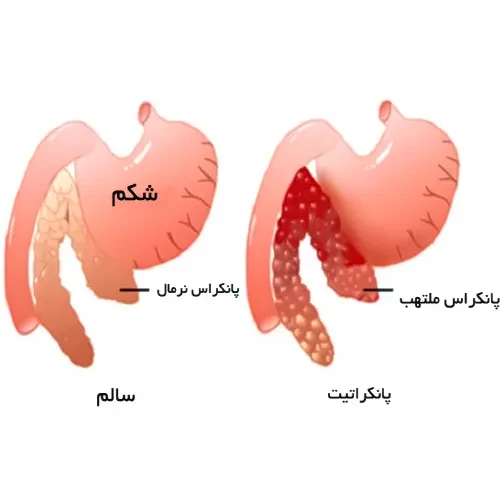 موارد احتیاطی مصرف داروی کیوترن