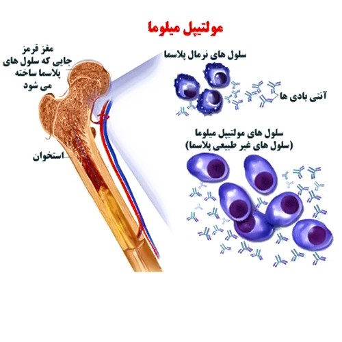 مصرف مولتیپل میلوما در سرطان