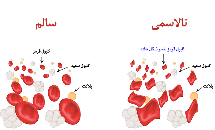 داروی دفریپرون در افراد مبتلا به تالاسمی