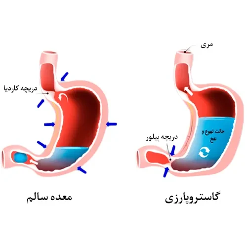 بیماری های معده از موارد احتیاطی مصرف داروی دولاگلوتید