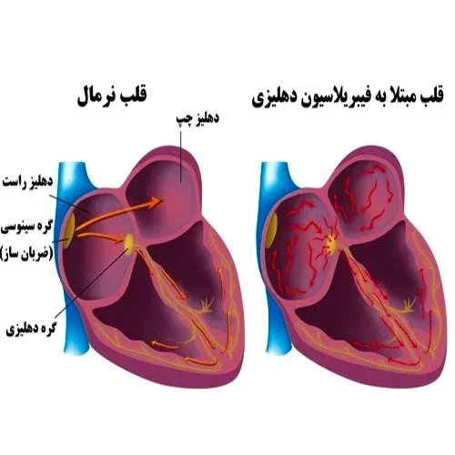 جلوگیری از انعقاد خون ناشی از فیبریلاسیون دهلیزی با داروی ادوکسابان