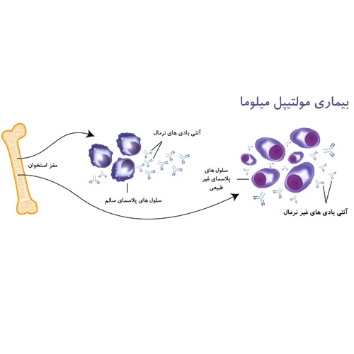 داروی امپلیسیتی (الوتوزوماب) جهت درمان بیماری مولتیپل میلوما