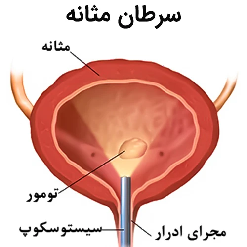 درمان سرطان مثانه با داروی پدسو (انفورتوماب ودوتین)