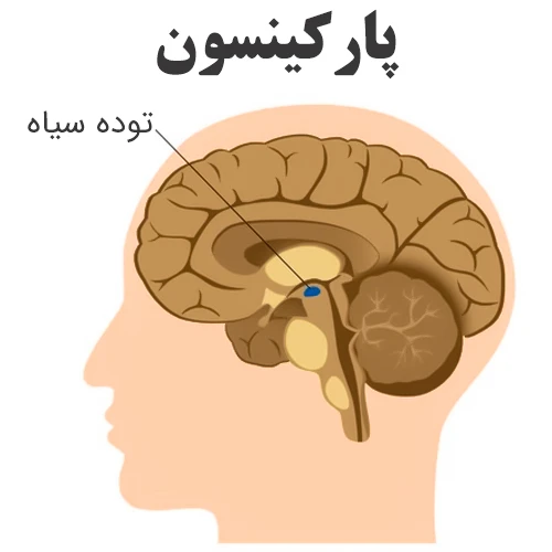 کنترل بیماری پارکینسون با داروی انتاکاپون