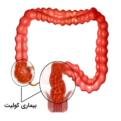 بیماری کولیت از موارد احتیاطی مصرف داروی ارتاپنم