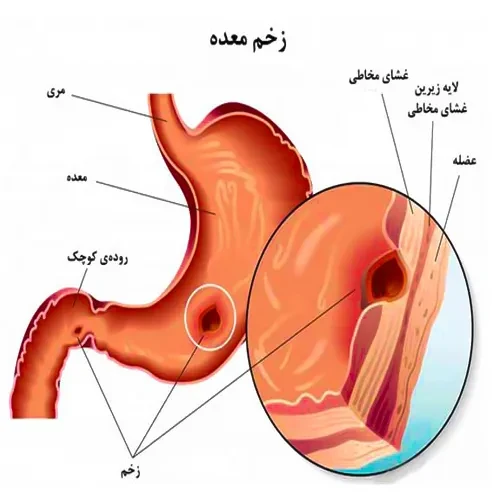 زخم معده از موارد احتیاطی مصرف داروی اس سیتالوپرام