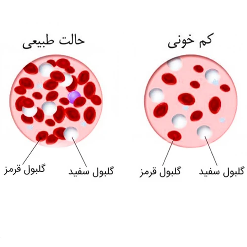 فرینجکت مورد استفاده در درمان کم خونی های شدید ناشی از فقر آهن