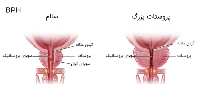 کوچک کردن پروستات بزرگ شده با داروی فیناستراید