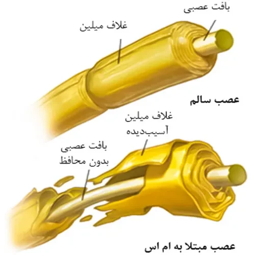 استفاده از داروی فینگولیمود در بیماری ام اس