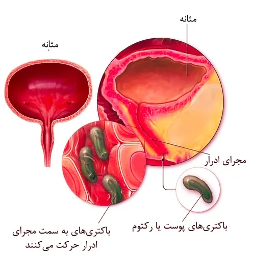 درمان عفونت مثانه با داروی فسفومایسین