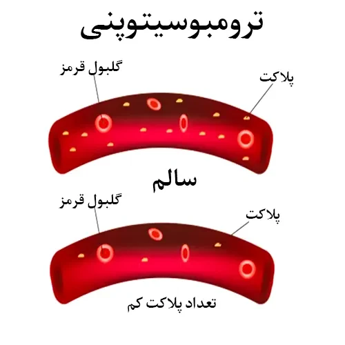 درمان بیماری ترومبوسیتوپنی مزمن با داروی فوستاماتینیب