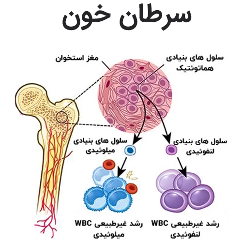 جمتوزوماب اوزوگامیسین و سرطان خون