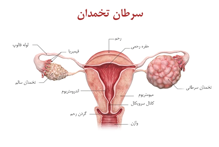 درمان سرطان تخمدان با داروی جمزار (جنسیتابین)