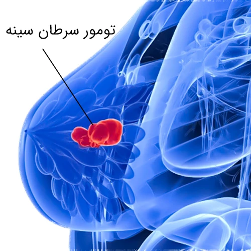 داروی فسگو استفاده در درمان تومور سرطان سینه