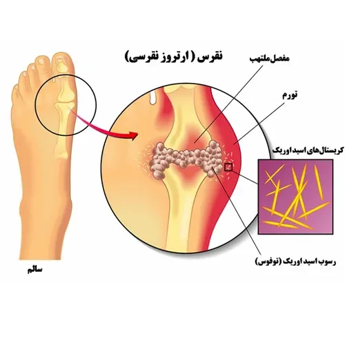 بیماری نقرس از موارد احتیاطی مصرف داروی آوالید