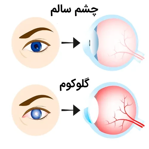 بیماری گلوکوم از موارد احتیاطی مصرف داروی هیدروکسی زین