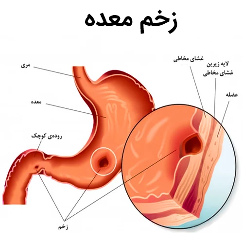 موارد احتیاط مصرف ایدلالیسیب