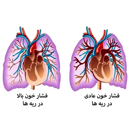 داروی آیلوپروست در درمان فشار خون بالا در ریه ها