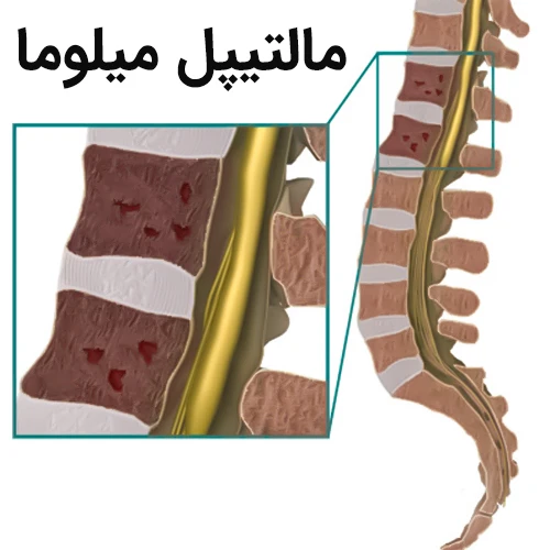 درمان مالتیپل میلوما با داروی ایزاتوکسیماب