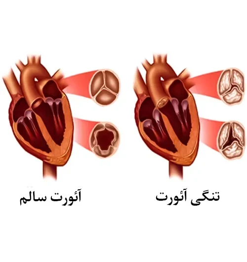 برخی عارضه قلبی از موارد احتیاطی مصرف داروی ایسرادیپین