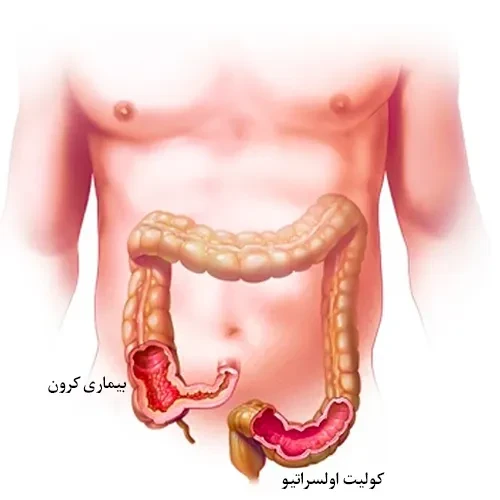 بیماری های روده ای از موارد احتیاطی مصرف داروی ایکسیکیزوماب