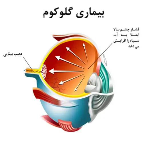 بیماری گلوکوم از موارد احتیاطی مصرف قطره کتوتیفن چشمی