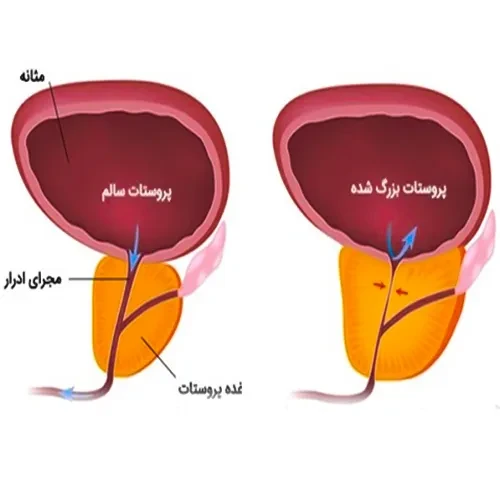 بزرگ شدگی پروستات از موارد احتیاطی مصرف داروی لووستیریزین