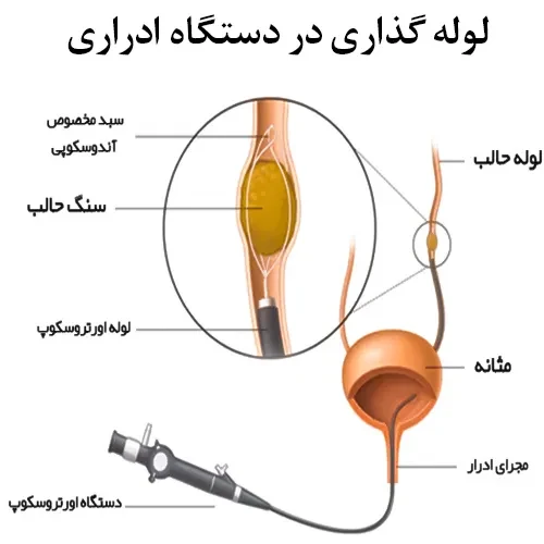 استفاده از ژل لیدوکائین قبل از لوله گذاری در دستگاه ادراری