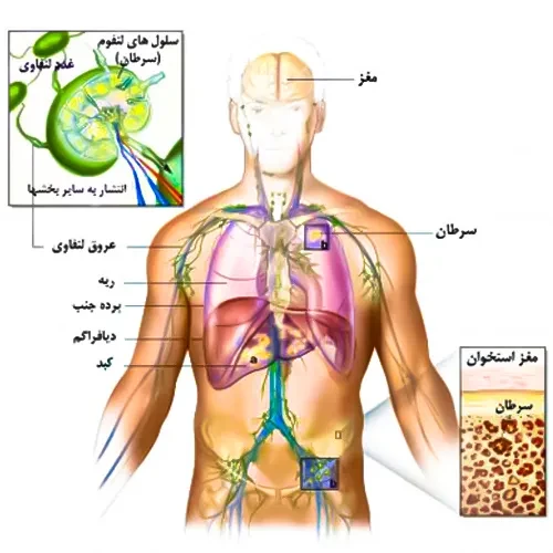 درمان لنفوم سلول بی با داروی لیسوکابتاژن مارالوسل