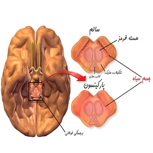 بیماری پارکینسون از موارد احتیاطی مصرف داروی لیتیوم