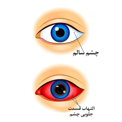 درمان التهاب چشمی با قطره چشمی زایلت