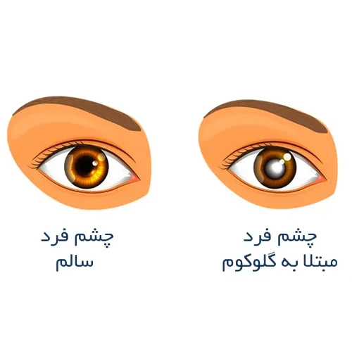 بیماری گلوکوم از موارد احتیاطی مصرف قطره چشمی زایلت