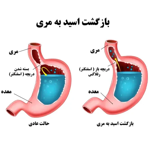 درمان رفلاکس معده با مصرف مکمل اکسید منیزیم