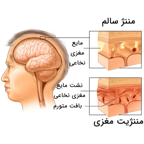 پیشگیری از ابتلا به مننژیت با واکسن مننگوکوک گروه بی