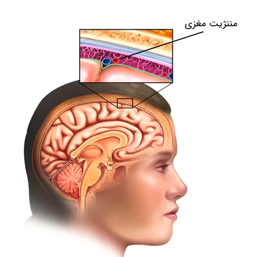 پیشگیری از ابتلا به مننژیت مغزی با واکسن پلی ساکارید مننگوکوک