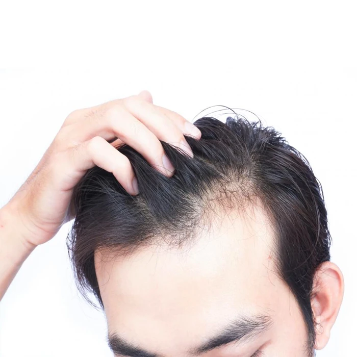 ریزش مو از عوارض داروی مرکاپتوپورین 