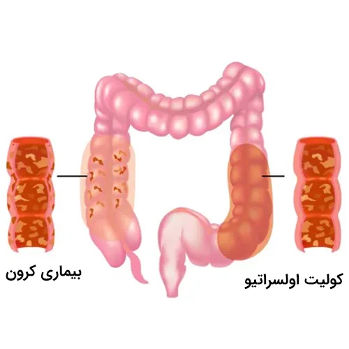 کنترل بیماری کولیت اولسراتیو با داروی مزالامین