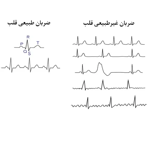 حفظ ضربان طبیعی قلب با داروی مکسیلتین