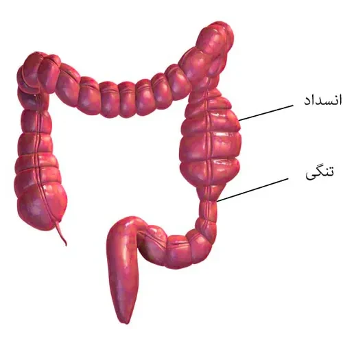 انسداد روده از موارد احتیاطی مصرف داروی میگلیتول