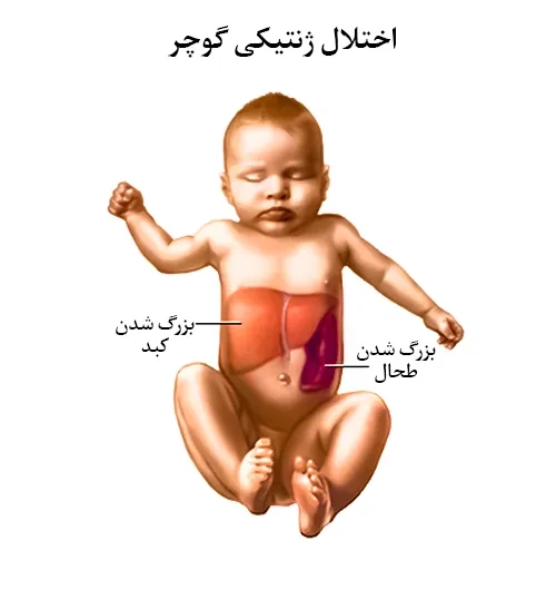 درمان اختلال ژنتیکی پوچر با داروی میگلوستات